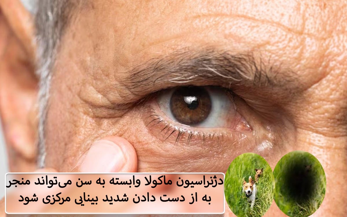 ارتباط بین سلامت چشم و بیماری آلزایمر در سالمندان (3)