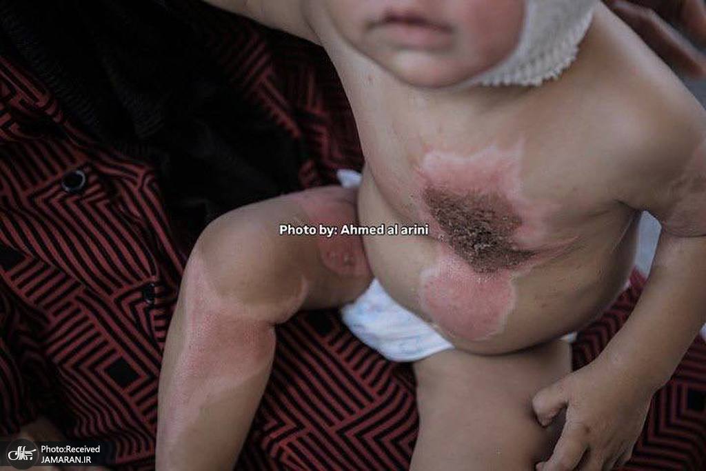 سوختگی شدید کودک فلسطینی بر اثر حمله صهیونیستها (5)
