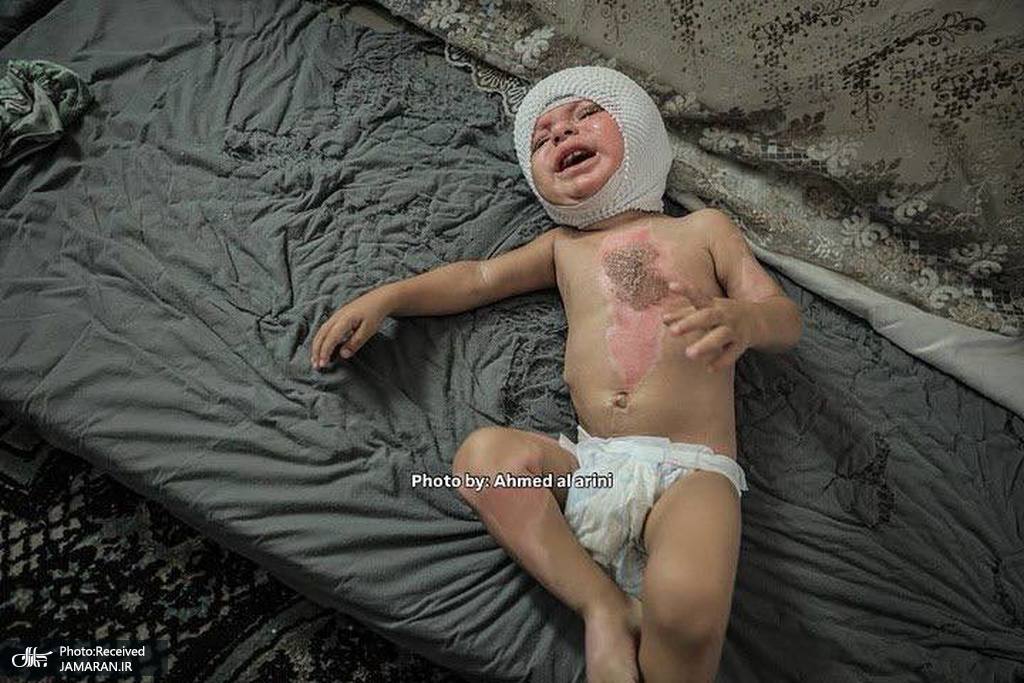 سوختگی شدید کودک فلسطینی بر اثر حمله صهیونیستها (4)