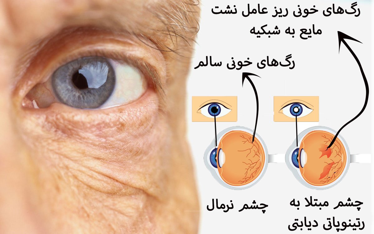 ارتباط بین سلامت چشم و بیماری آلزایمر در سالمندان (2)