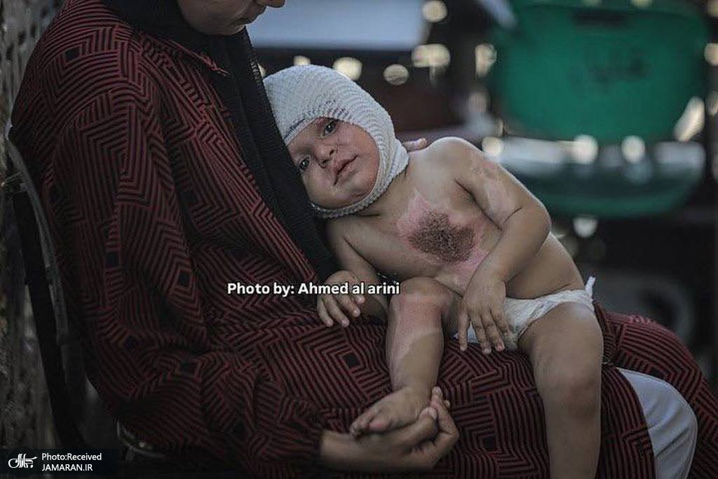 سوختگی شدید کودک فلسطینی بر اثر حمله صهیونیستها (2)