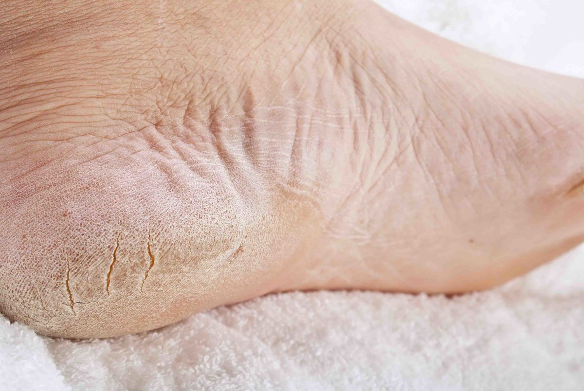 با 9 روش خانگی ترک پای خود را درمان کنید
