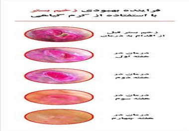 آغاز درمان بیماران زخم بستر با نخستین داروی ایرانی