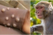 آبله میمون افراد بالای ۵۱ سال را مبتلا نمی‌کند
