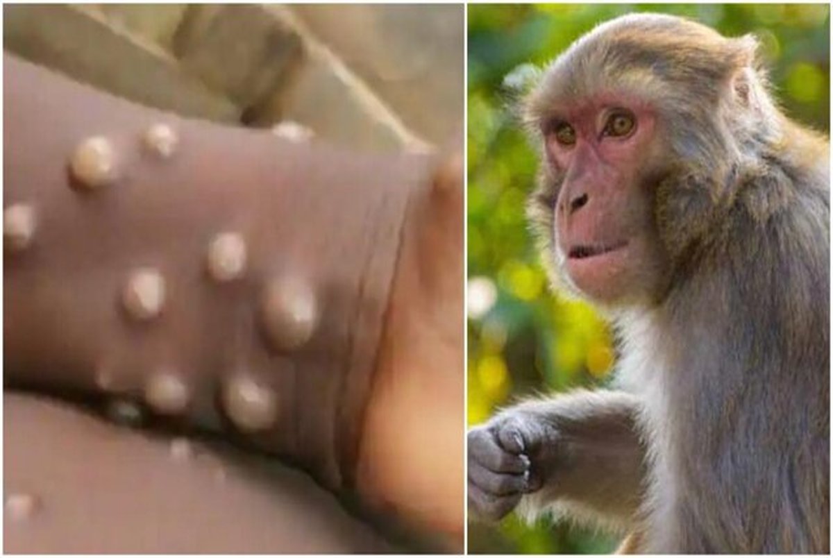 شناسایی علائم جدید آبله میمون
