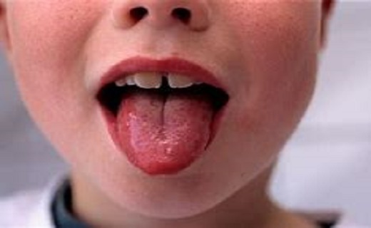 علائم تب مخملک چیست؟
