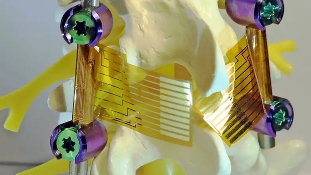 ایمپلنت‌ها هوشمند می‌شوند
