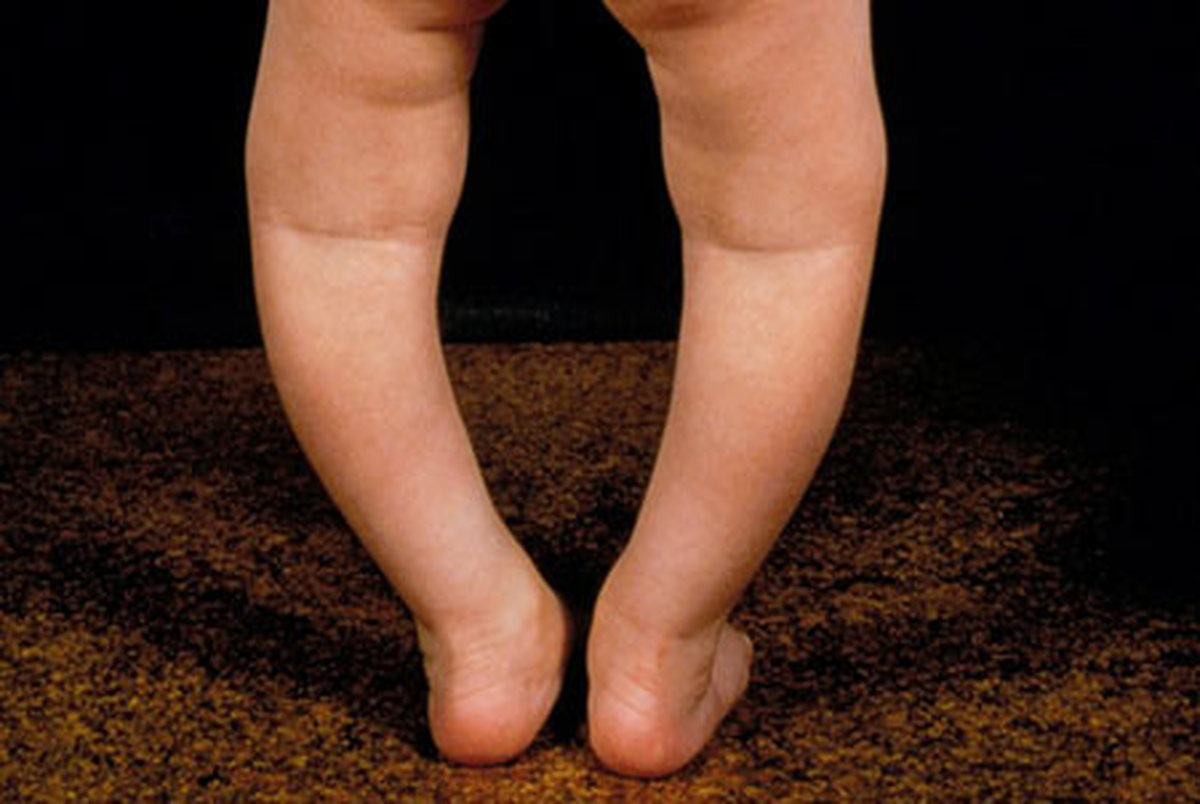 چرا کودکان دچار پای پرانتزی می شوند؟
