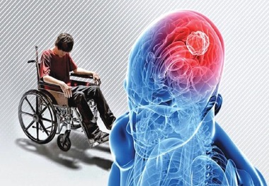 کودکان مبتلا به «ام اس» زودتر پیر می‌شوند
