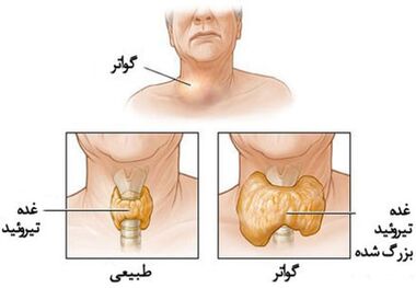 بیماری گواتر در خراسان رضوی کاهش یافت