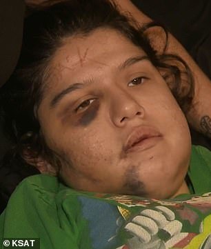 اقدام وحشتناک پسر جوان؛ اسمش را روی صورت دختر مورد علاقه اش هک کرد!/ عکس