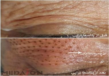 بلفاروپلاستی بدون جراحی (درمان افتادگی پلک)
