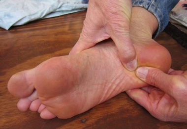 
درمان خانگی خار پاشنه