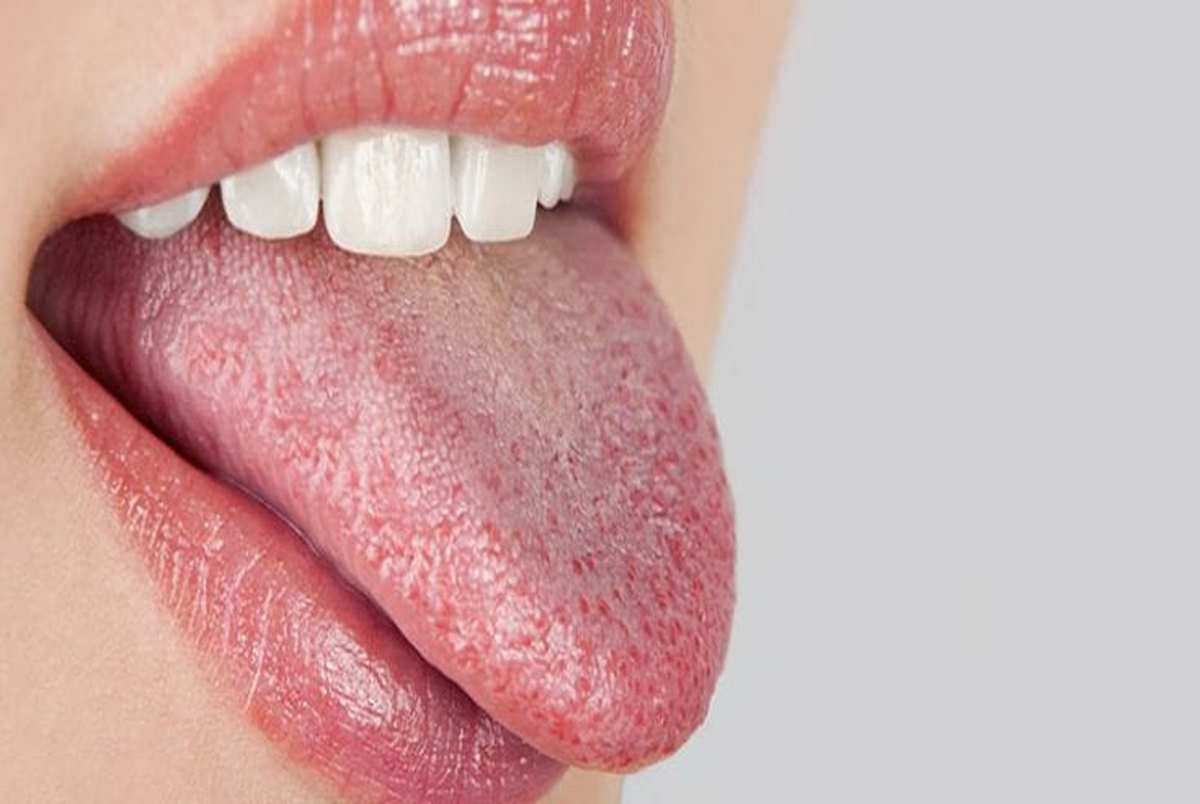 چیزهایی که باید از خشکی دهان بدانید