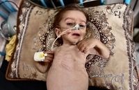 وخامت وضعیت سلامت کودک سه‌ساله غزه‌ای بر اثر سوءتغذیه و محاصره (7)