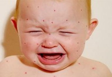 ابتلای سالانه ۱۰۰ هزار کودک به سندرم سرخجه مادرزای