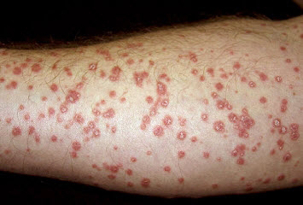 بیماران پسوریازیس به افسردگی مبتلا می‌شوند