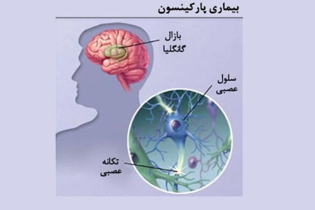 خط اول درمان پارکینسون در مشهد راه اندازی شد