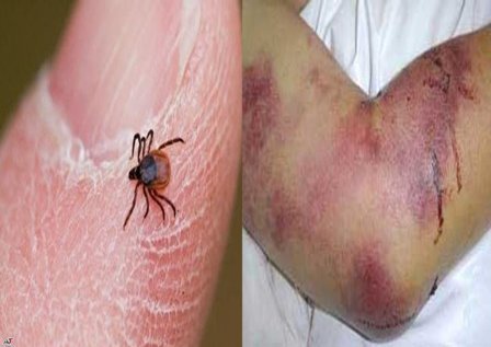 9 بیمار مشکوک به بیماری تب کریمه کنگو در کرمان شناسایی شدند