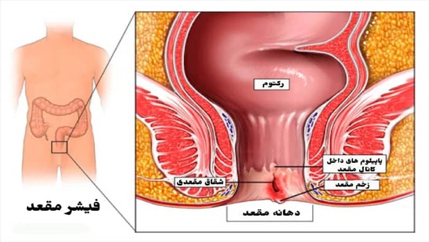 درمان شقاق با روشهای عمل جراحی و لیزر؛ کدام بهتر است؟