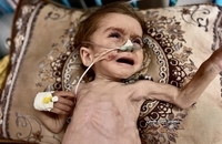 وخامت وضعیت سلامت کودک سه‌ساله غزه‌ای بر اثر سوءتغذیه و محاصره (2)