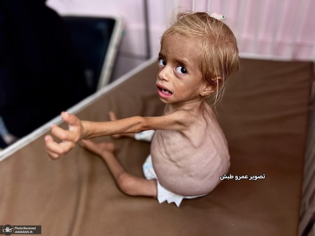 تصاویر دردناک از کودک دو ساله غزه‌ای در مراحل بحرانی سوءتغذیه به دلیل قحطی