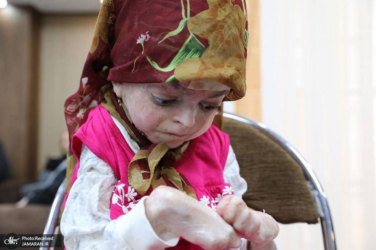 جان باختن 15 تن از بیماران پروانه‌ای ایران در دوره تشدید تحریم های آمریکا/  تحریم‌های آمریکا و کارشکنی‌های سوئد مانع دسترسی کودکان‌ «ای‌بی» به پانسمان‌ شد