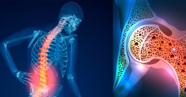 بهترین راه برای پیشگیری از پوکی استخوان