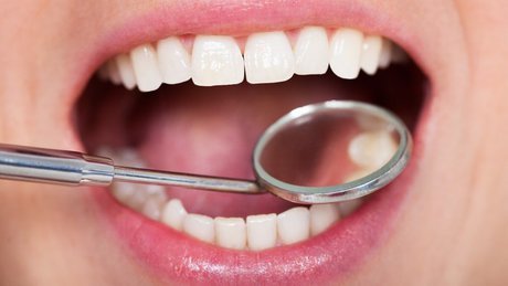 پر کردن دندان با "کامپوزیت" بهتر است یا "آمالگام"؟