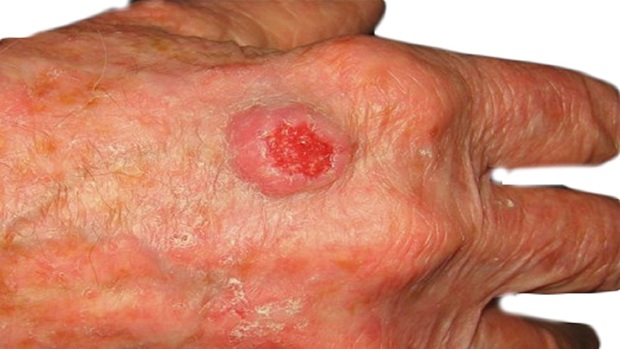 شناسایی یک جاسوس سلولی مهم در ابتلا به سرطان پوست
