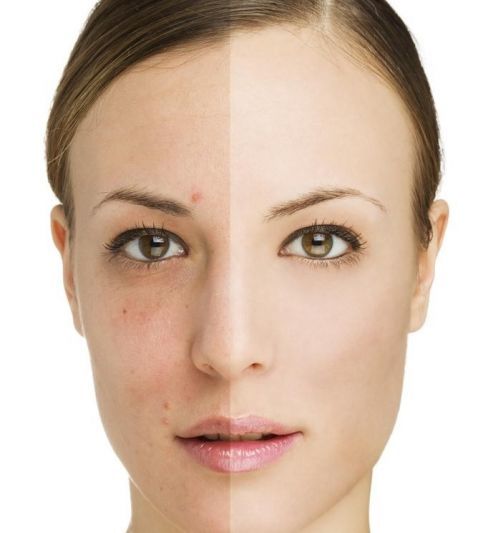 آکنه و اگزما از شایع ترین مشکلات پوستی در ایران