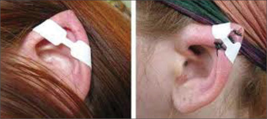 جراحی مدل "گوش الاغی" به ایران رسید+ عکس