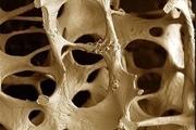 6 هشدار درباره پوکی استخوان در مردان