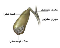 چه کسانی در معرض خطر سنگ کیسه صفرا هستند؟