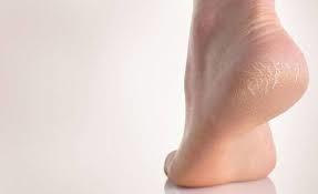 درمان خانگی ترک کف پاها
