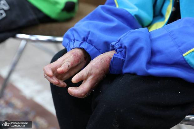 آخرین وضعیت بیماران پروانه‌ای در ایران/ مدیرعامل «خانه‌ ای بی»: دولت باید به یاری این عزیزان بشتابد/ در زمینه تولید و کیفیت داروها مشکلی نداریم، تنها برای تهیه پانسمان آن هم به دلیل تحریم‌ها در مضیقه هستیم