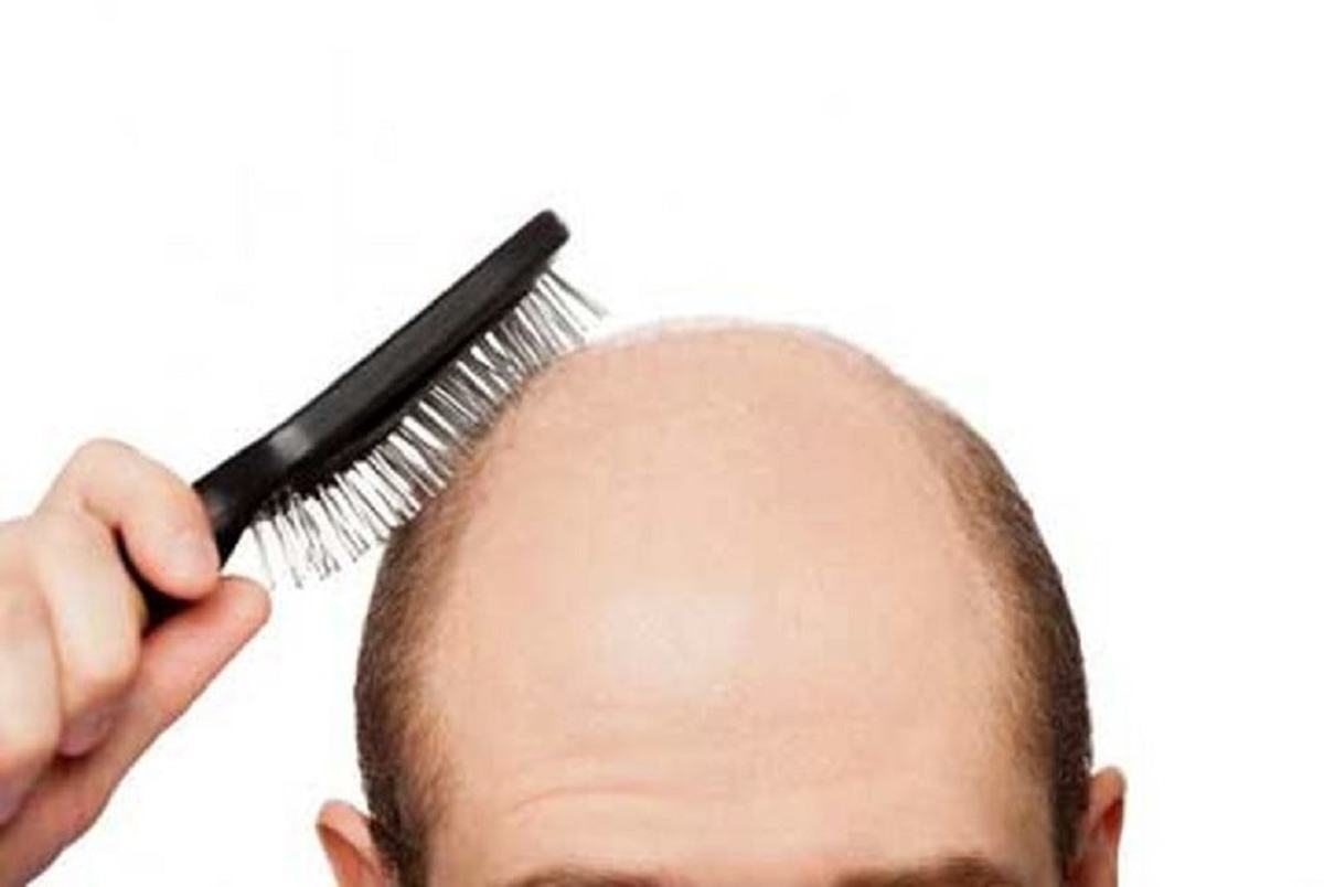 درمان ریزش مو و طاسی با تزریق چربی ممکن شد؟ / تحقیقی که نتایج موفقیت آمیزی داشت!
