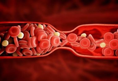 افزایش احتمال لختگی خون با رگ های واریسی پا