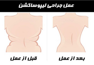 تب پیکرتراشی و خطر لیپوساکشن