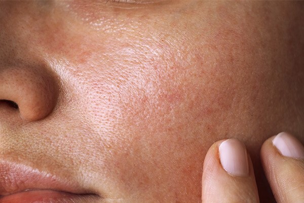 لکه‌های پوستی را چگونه درمان کنیم؟