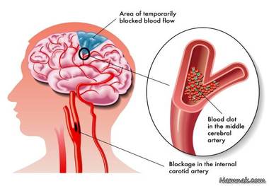 سکته مغزی به شرط انتقال سریع بیمار قابل درمان است