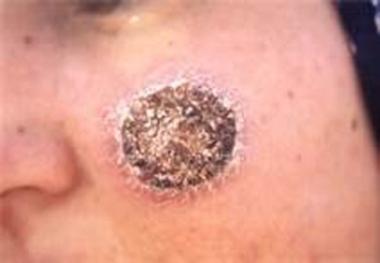 آغاز دومین مرحله مقابله با مخزن بیماری سالک در  ارسنجان