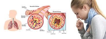 تروموپلاستی روش درمانی جدید برای بیماری آسم + ویدیو